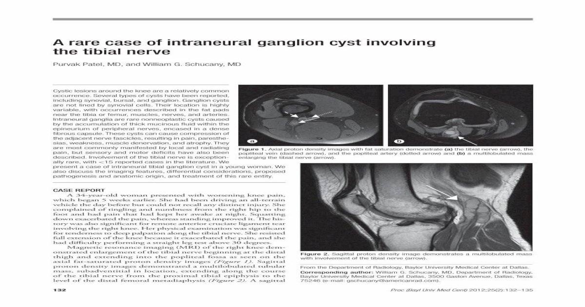 A Rare Case Of Intraneural Ganglion Cyst Involving The Tibial Nerve
