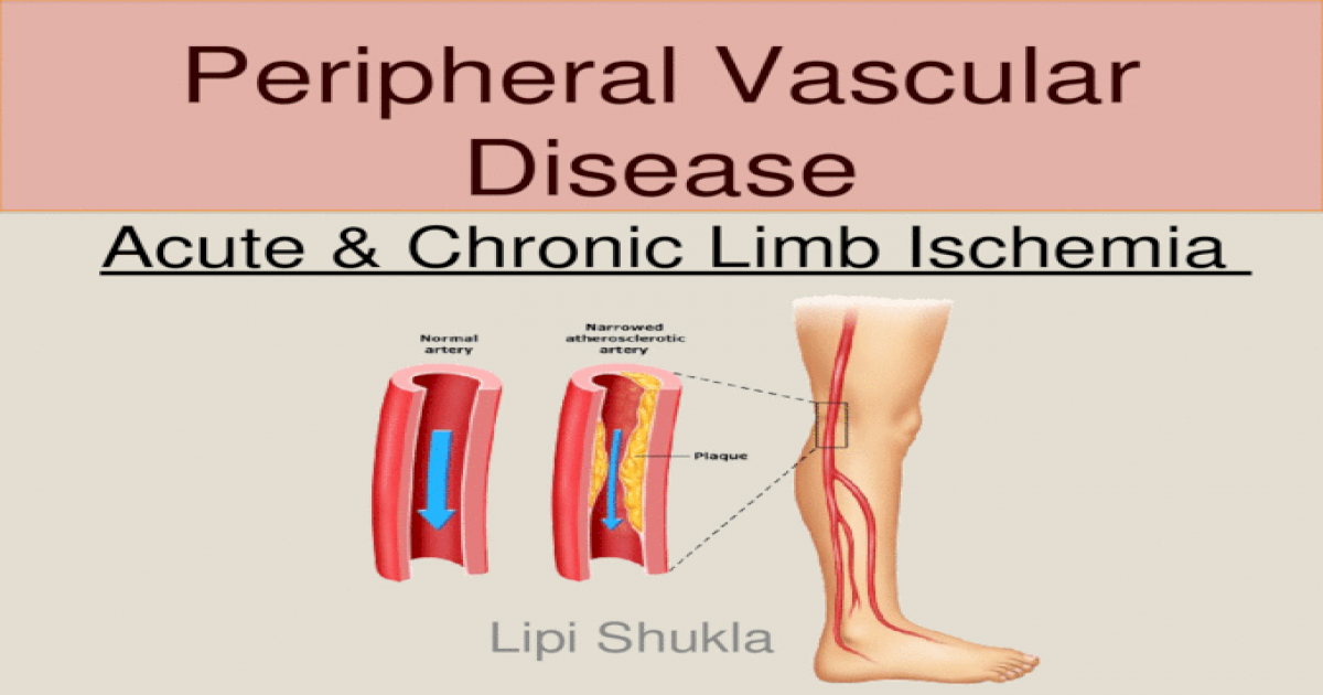 Peripheral Vascular Disease Acute And Chronic Limb Ischemia Ppt